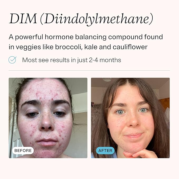 MDacne DIM Skin Clearing Supplements (90 Capsules) - for Acne Treatment, Estrogen Balance, Hormone Menopause Relief & Bodybuilding, Cruciferous Extract & Bioperine - Dermatologist Formulated (3 Pack)